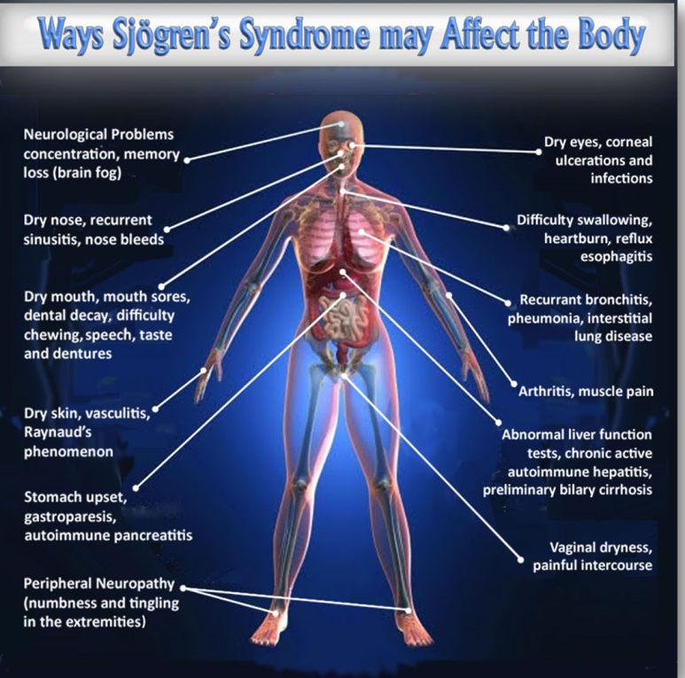 쇼그렌증후군(Sjogren's syndrome, 쉐그렌증후군) 인공눈물 필요 없어지다 네이버 블로그