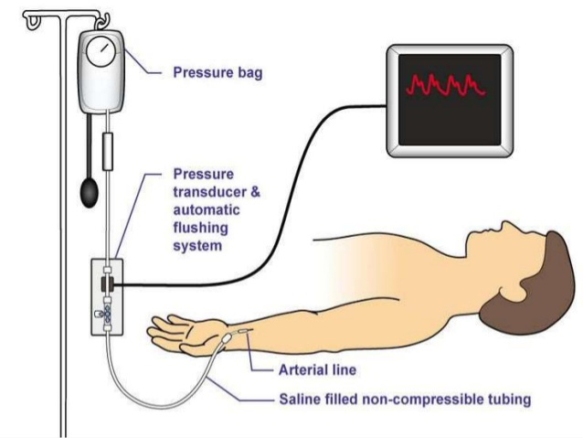 arterial-line-monitoring-a-line-abp
