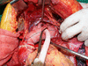 Aortic Arch Replacement