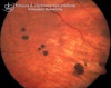 bear tracks retina treatment